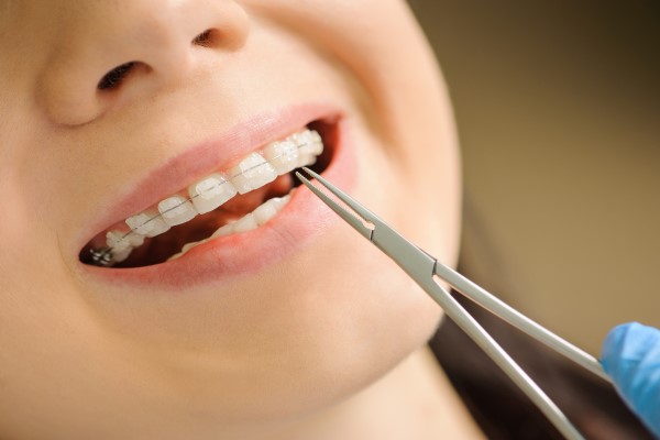 How Clear Braces Can Give You Straighter Teeth