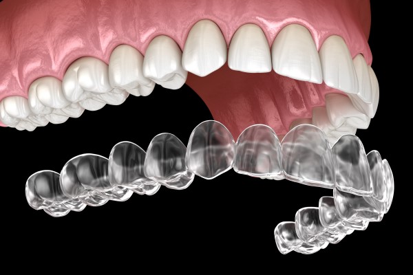 How Long Will Invisalign Aligner Therapy Last?